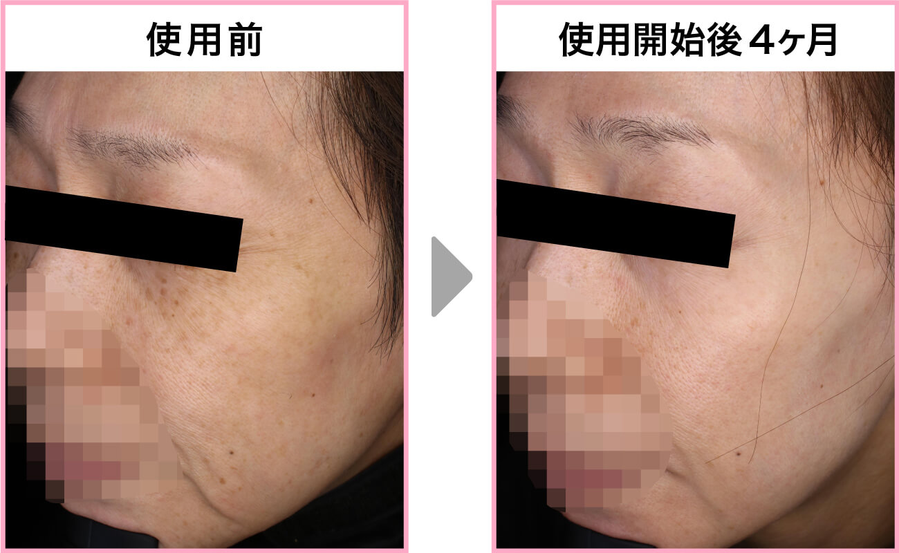 ゼオスキンヘルス Qスイッチヤグレーザー併用症例50代女性事例 右側面写真