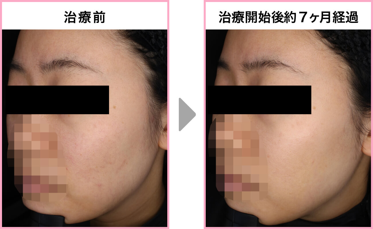 20代・女性 ゼオスキンヘルス 青ライン(アクティブメンテナンス) 症例写真左側面