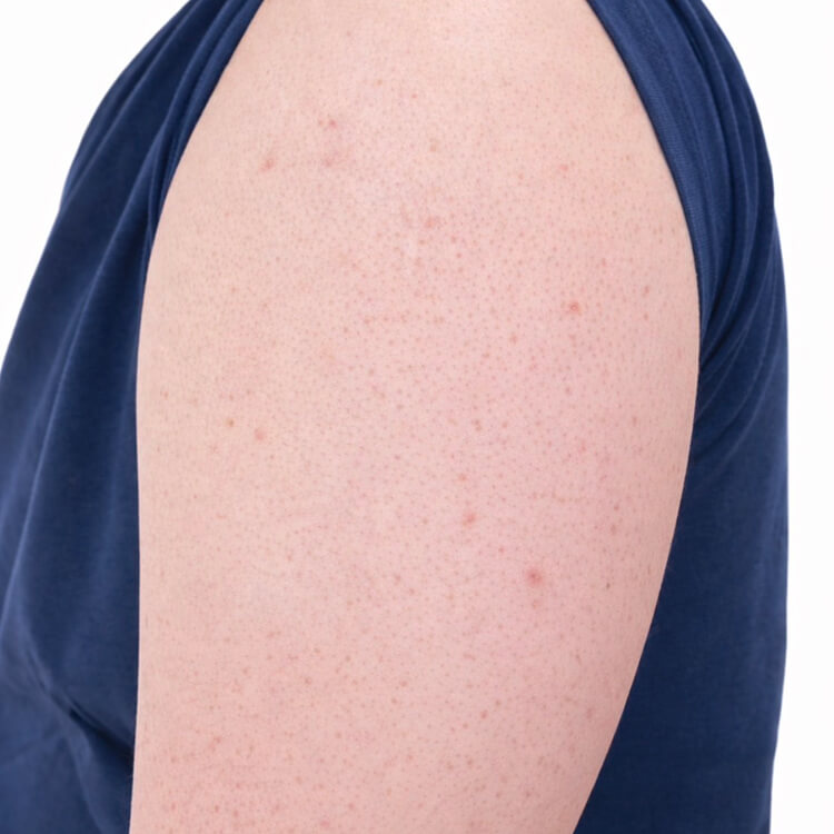 毛孔性苔癬のイメージ