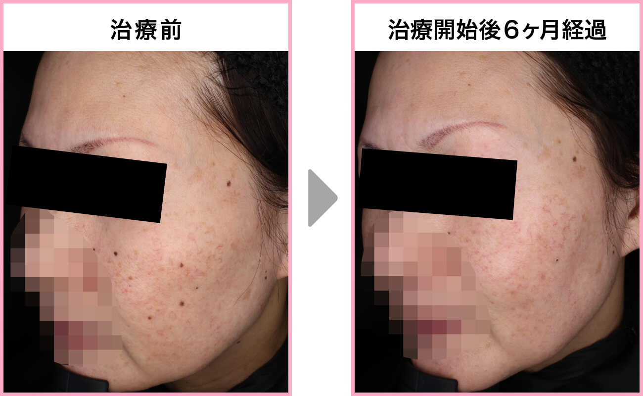 60代・女性［炭酸ガスレーザー モニター］症例写真右側面