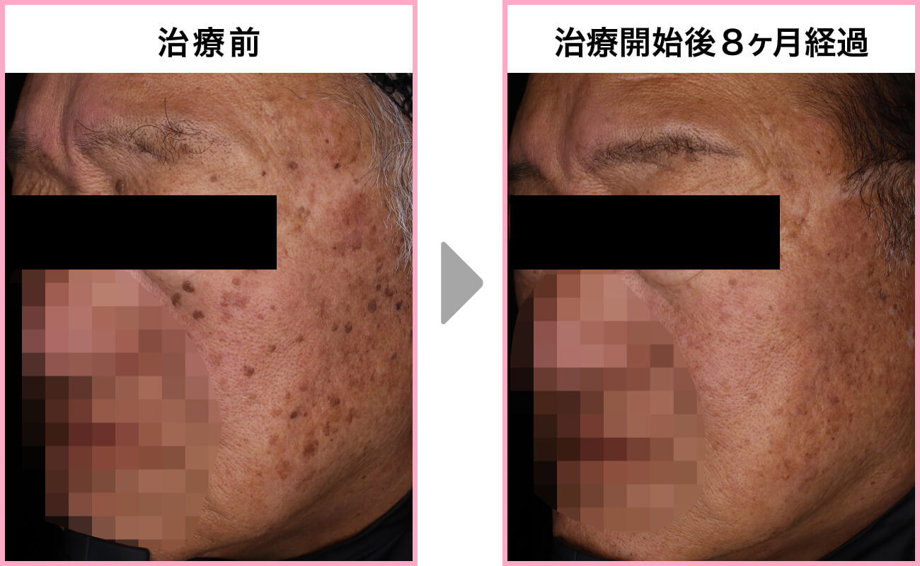 60代・男性 [Qスイッチヤグレーザー+炭酸ガスレーザー モニター]右側面