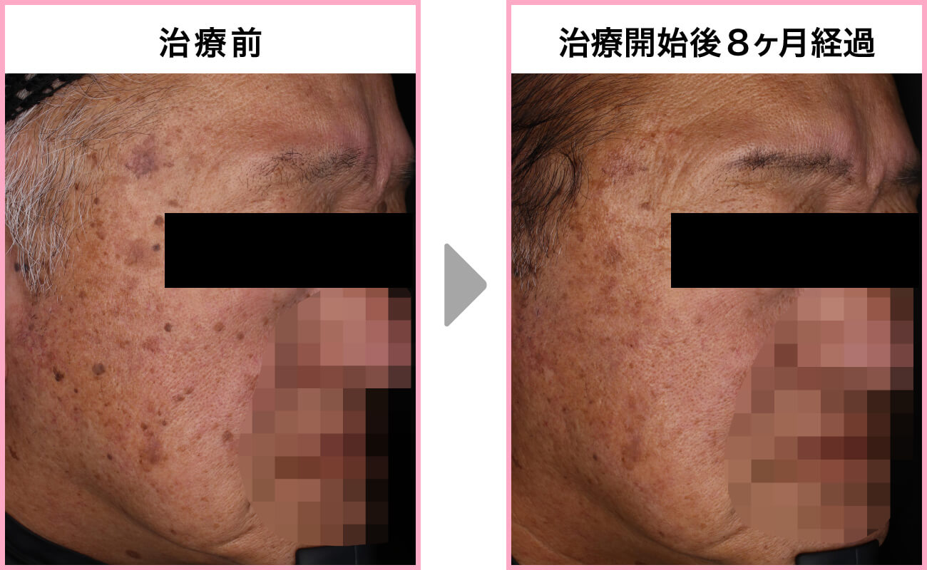 60代・男性 [Qスイッチヤグレーザー+炭酸ガスレーザー モニター]左側面
